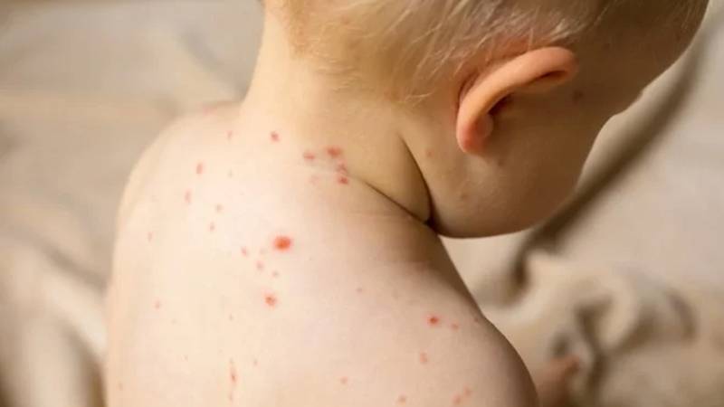 ٹیکساس میں خسرہ کی وبا بے قابو، بچوں میں کیسز 58 تک پہنچ گئے