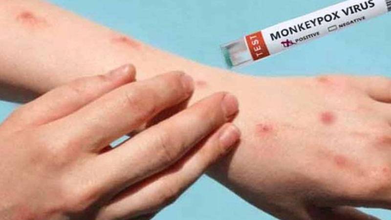 کراچی: جناح ہسپتال میں منکی پاکس کے مشتبہ مریض کو آئسولیشن وارڈ منتقل کر دیا گیا