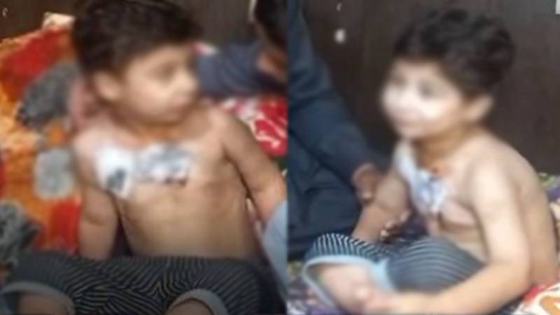 شاہ جمال کالونی: 4 سالہ فواد پر پالتو کتے کا حملہ، گردن و کمر پر گہرے زخم