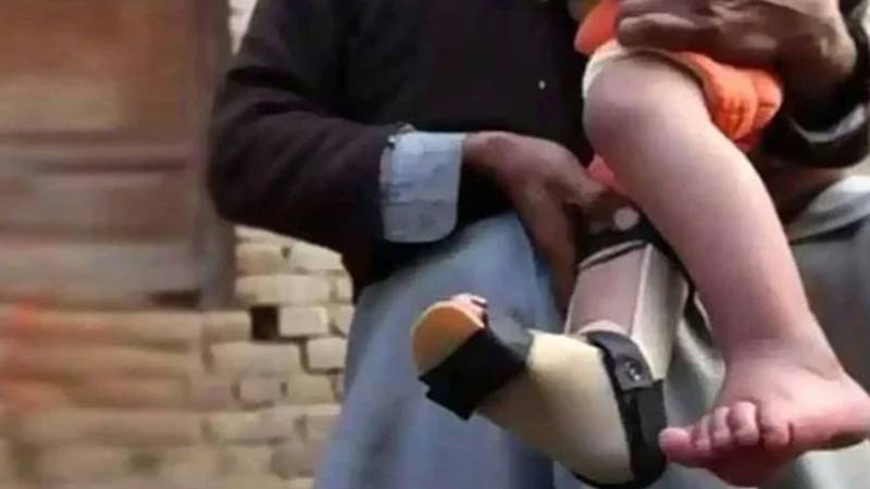 پشاور میں پولیو کے ایک اور کیس کی تصدیق، کیسز کی تعداد میں اضافہ