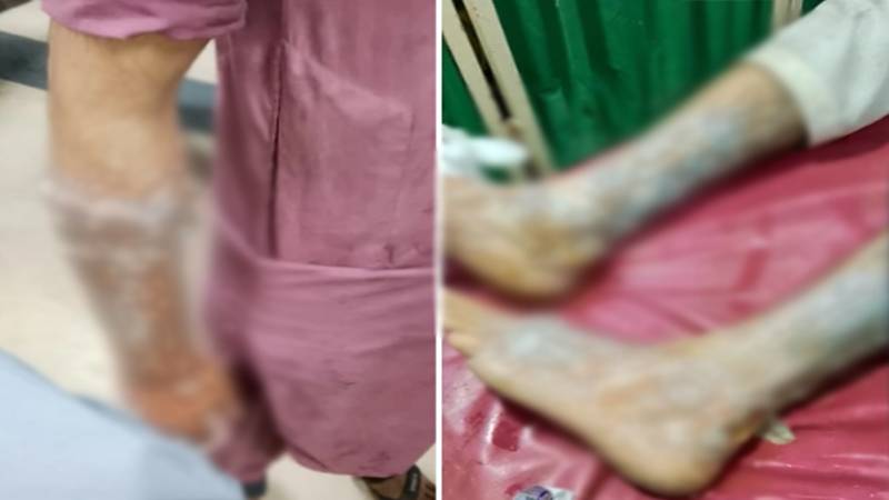 ناشتے کے بل پر جھگڑے کے دوران ملزم کا حملہ، بچے زخمی، چاقو اور گرم دودھ کا حملہ