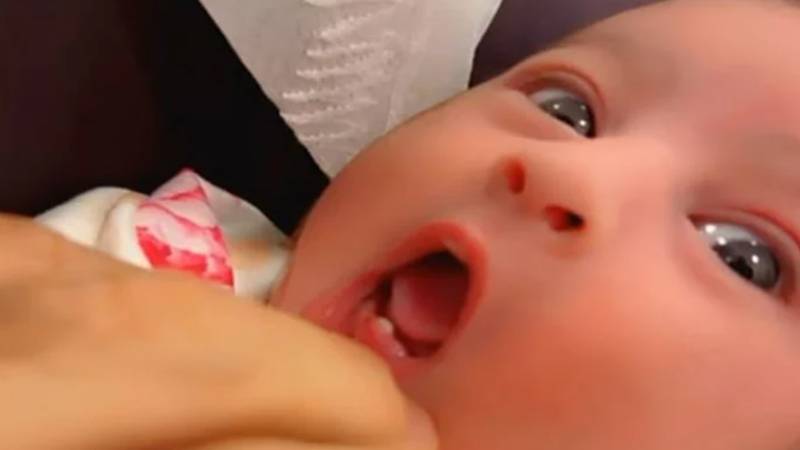 شارجہ میں 6 دن کی بچی کے دانت نکل آئے، ڈاکٹروں نے نایاب کیس قرار دے دیا