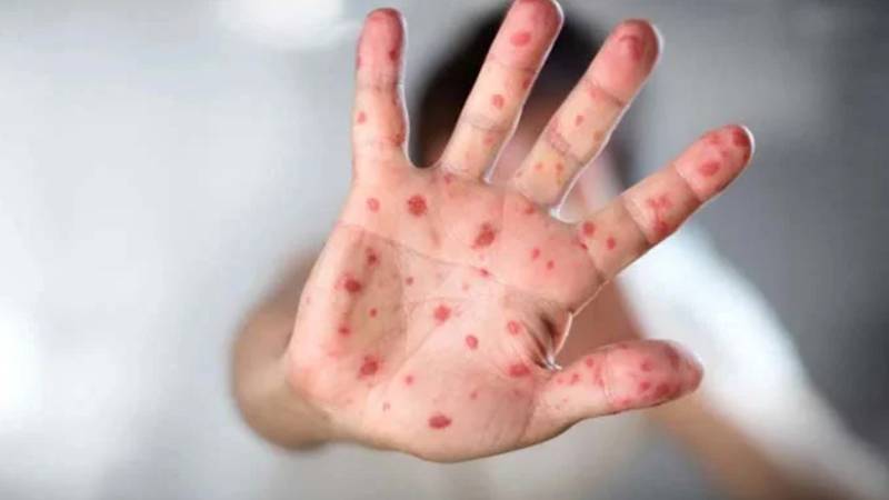 کبیروالا: خسرے سے 7 بچوں کی ہلاکت، ہنگامی اقدامات کا مطالبہ