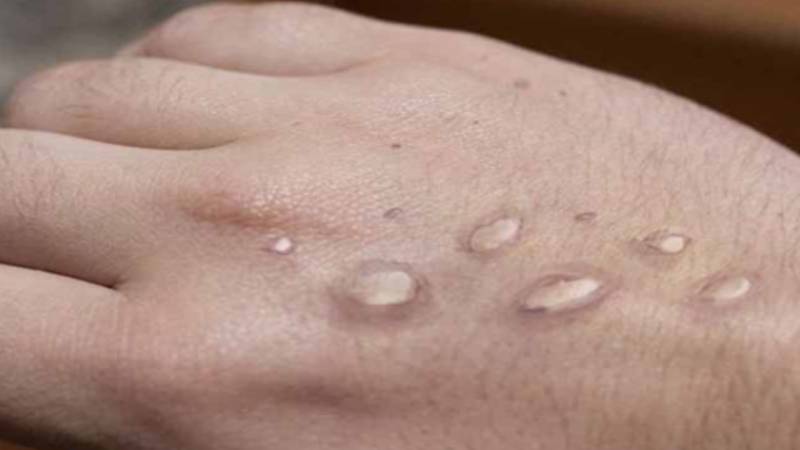سندھ میں منکی پاکس کے کیسز کی تعداد 3 تک پہنچ گئی، کراچی میں دوسرا مریض رپورٹ